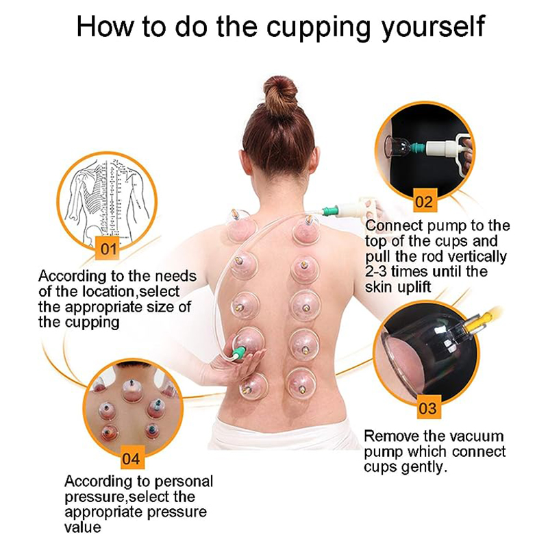 24 latas JINGKANG Conjunto de  - Cupping Therapy Set avaliação e preço